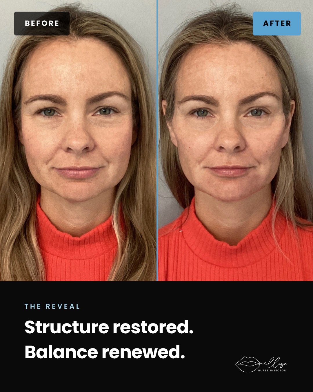 Front reveal — structure restored