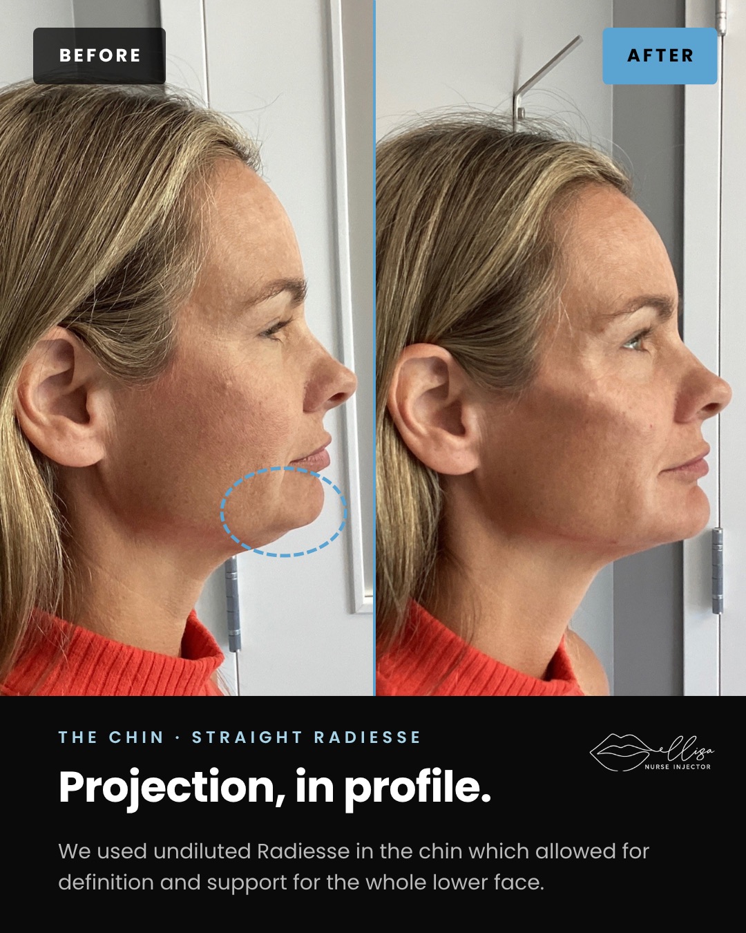 Chin profile — projection in profile