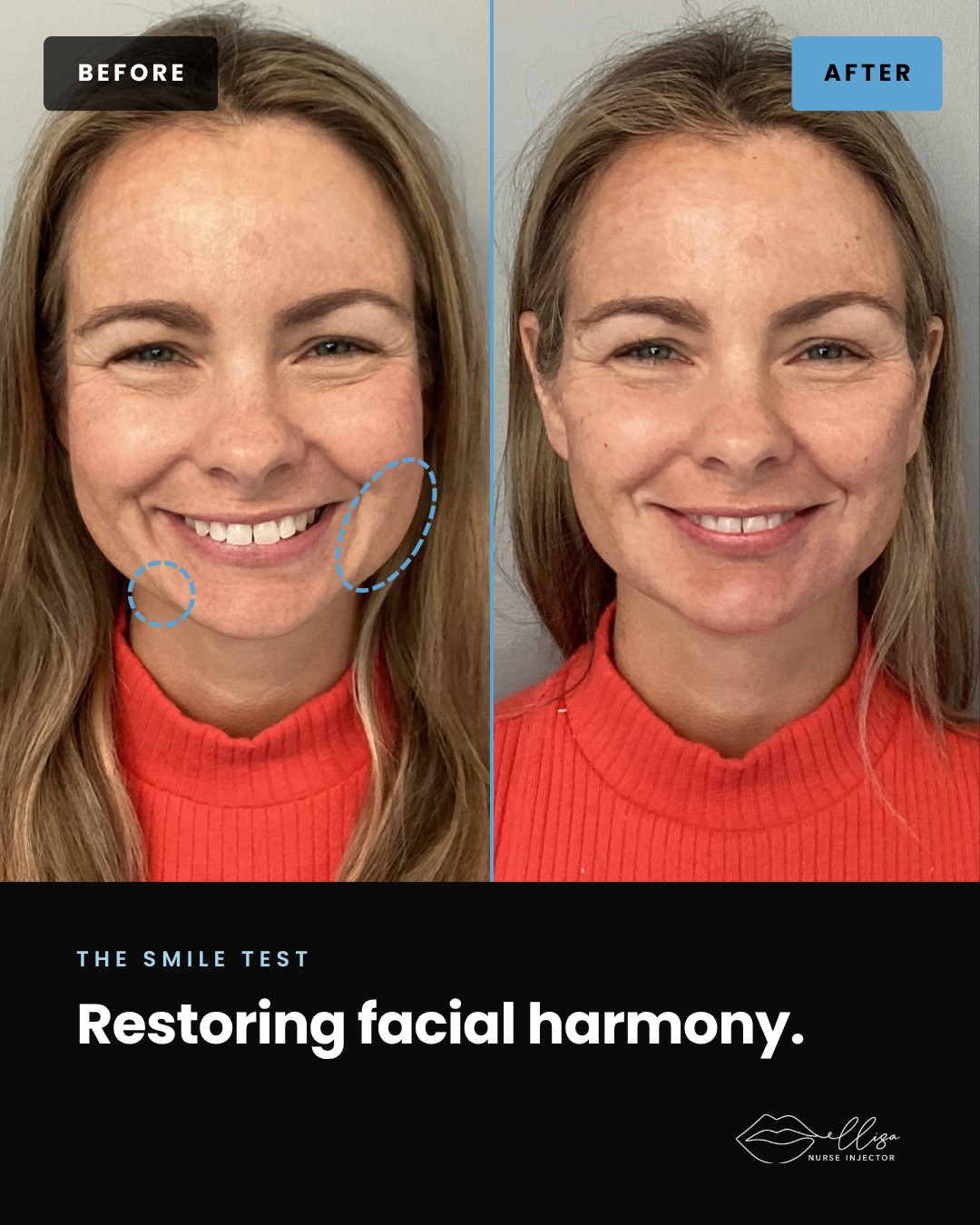 The smile test